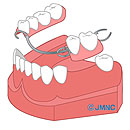 入れ歯治療のイメージ