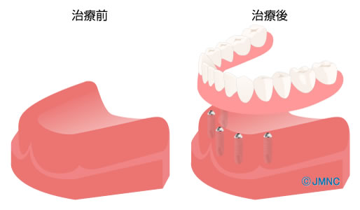 インプラント治療の歯科医院向け 無料イラスト素材集 インプラントネット