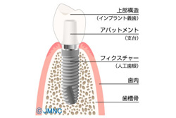 インプラント治療とは