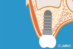 サイナスリフトについて