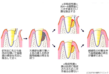 再生療法-歯周組織の再生 | インプラントネット