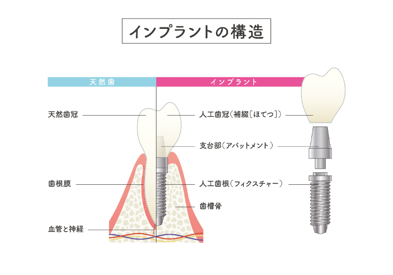 インプラント 種類