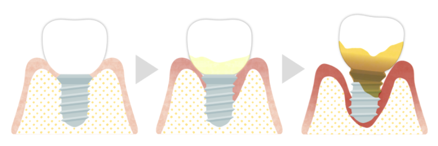 インプラント周囲炎