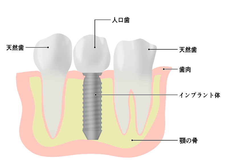 インプラント　ぐらぐら