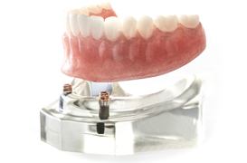 入れ歯やブリッジでお悩みの方インプラント義歯とは？