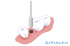 歯茎の切開をしないでインプラント治療を行うフラップレス術式とは？